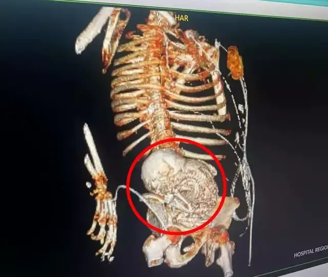 Imagem de compartilhamento para o artigo Descoberta rara: paciente de 86 Anos abriga feto mumificado por cinco décadas em MS da MS Todo dia